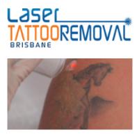 Laser Tattoo Removal Brisbane  image 1